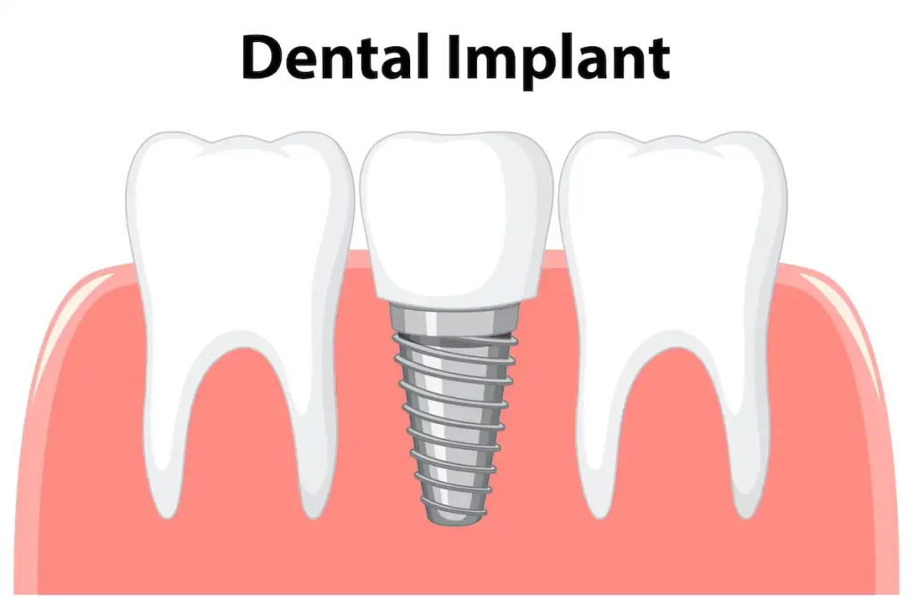 dental implants